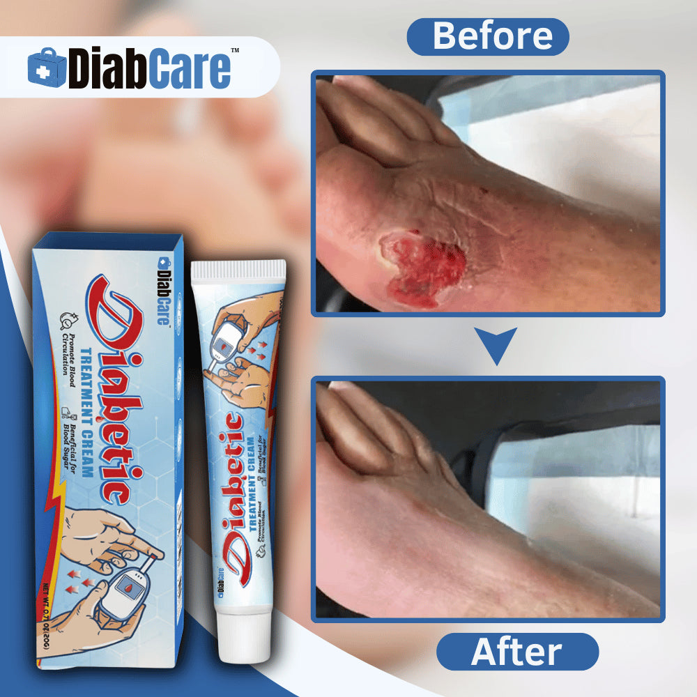 DiabCare™ Diabetinis gydomasis kremas | Jokio skausmo dėl diabetinių žaizdų iš karto!