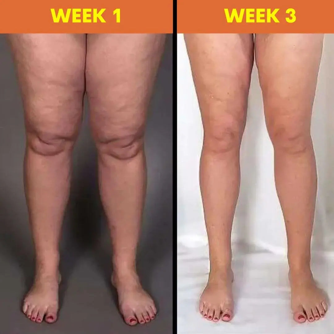 Edema™ masažuoklis | Vienu naudojimu sumažinkite sunkumo ir įtampos jausmą kojose!