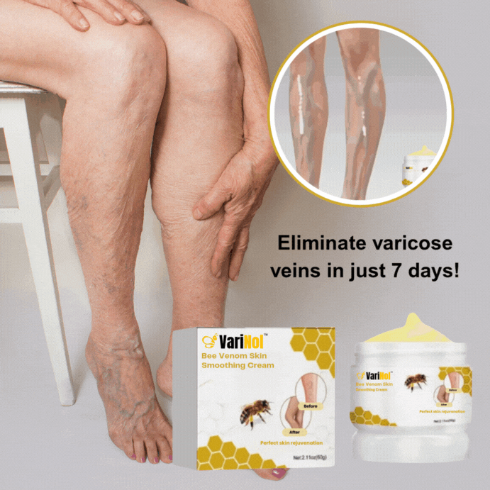 „VariNol™“ kremas nuo venų varikozės | Atsikratykite venų varikozės vos per 7 dienas!