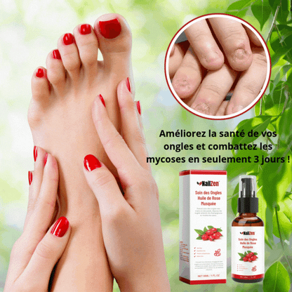 NailZen™ Nagų priežiūra su rožių aliejumi | Pagerinkite savo nagų sveikatą ir kovokite su grybelinėmis ligomis vos per 3 dienas!