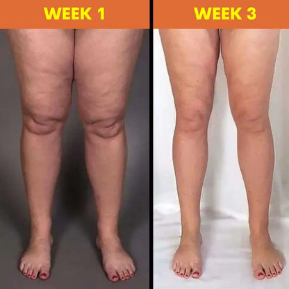 Edema™ masažuoklis | Vienu naudojimu sumažinkite sunkumo ir įtampos jausmą kojose!
